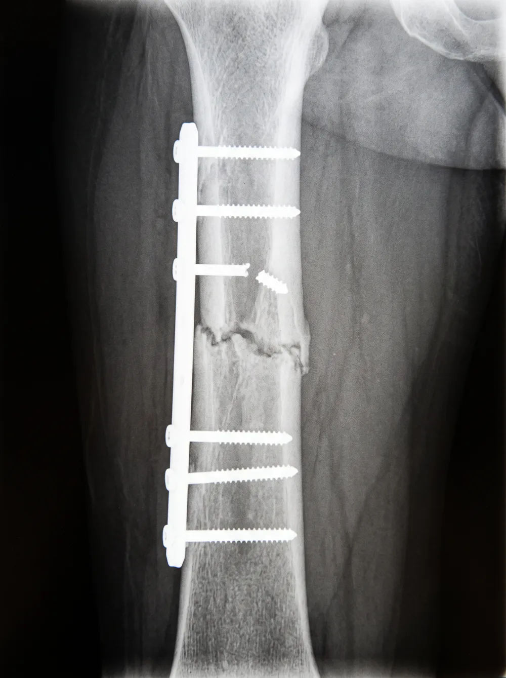 An X-ray of a plate and screws holding a broken shin bone
